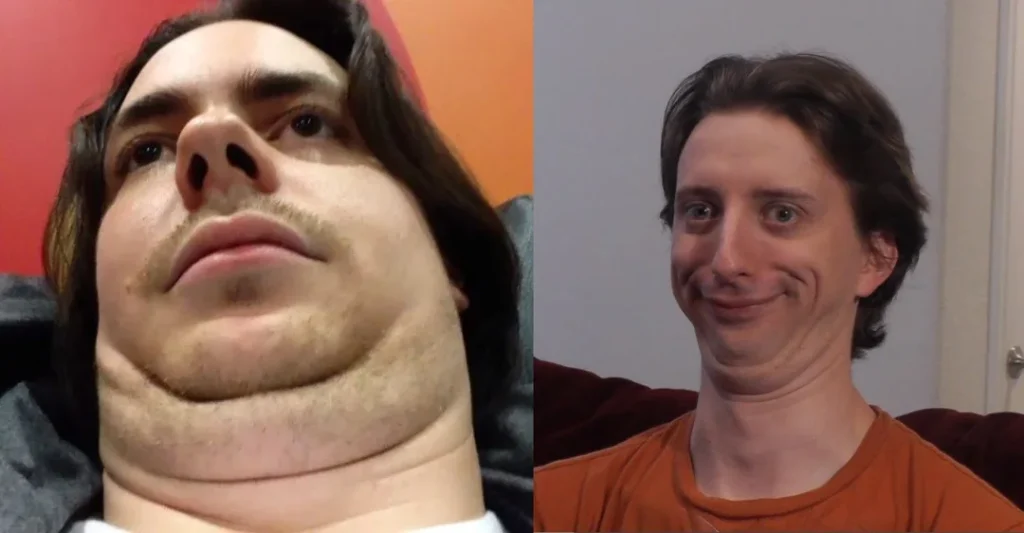 The Double-Chin Disaster