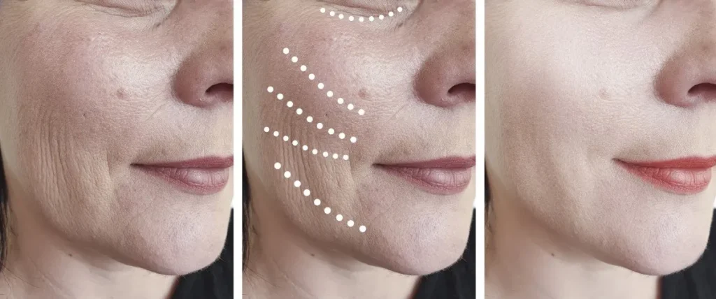 https://www.oralfacialimplant.com.au/cheek-lift