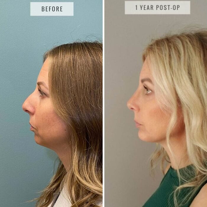 Side-by-side photos of a person one year after a rhinoplasty and chin implant, with a straighter nose, enhanced chin projection, and more defined profile.