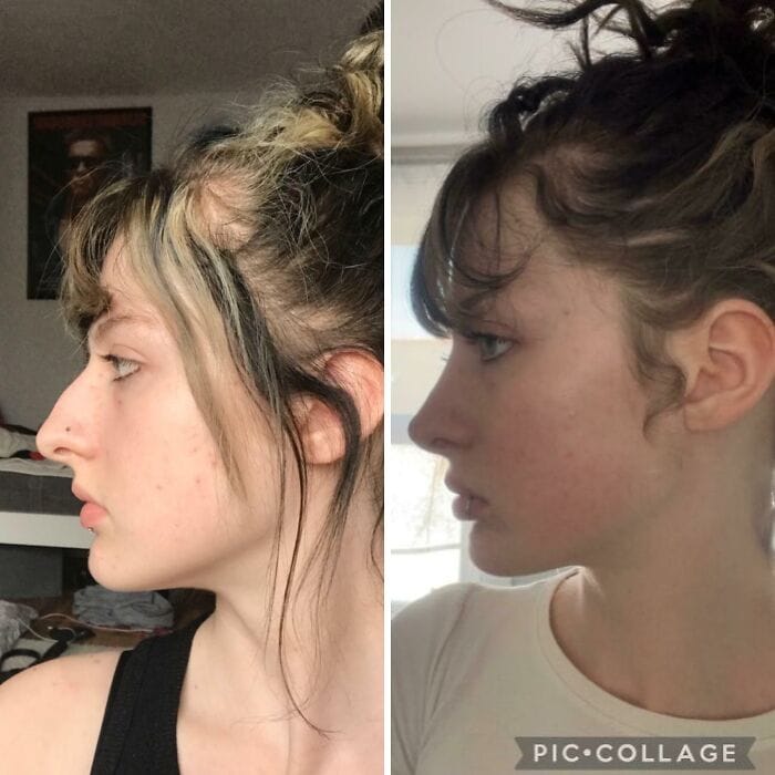 Before-and-after pictures of a person one year after rhinoplasty, with a refined nose shape, improved nasal bridge contour, and natural-looking results that complement their facial profile.