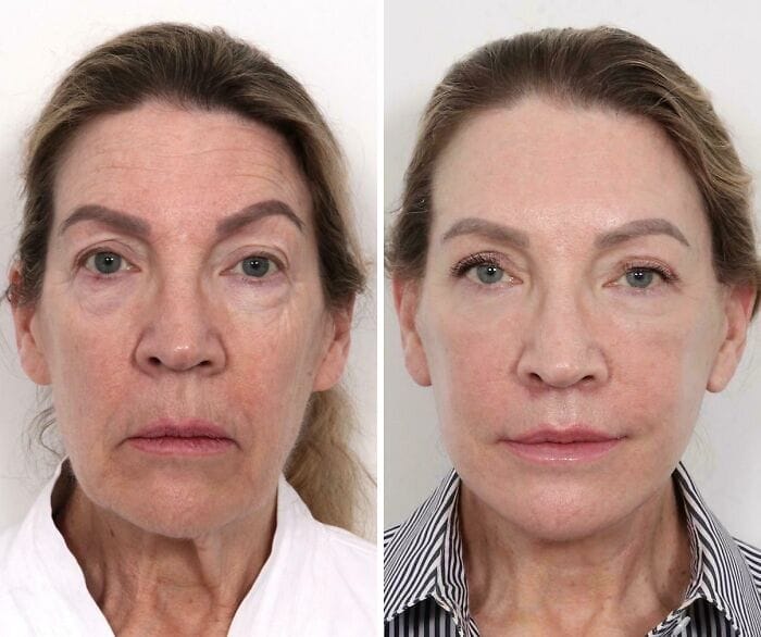 Before-and-after photos of a woman seven weeks after a facelift, brow lift, and eyelid surgery, revealing smoother skin, lifted features, and a rejuvenated, natural look after significant weight loss.