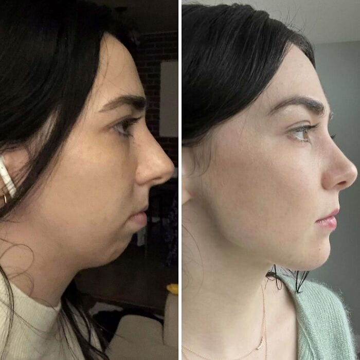 Side-by-side before-and-after images of a person 9.5 months after jaw surgery, showing a more balanced facial structure with improved jaw alignment and definition.