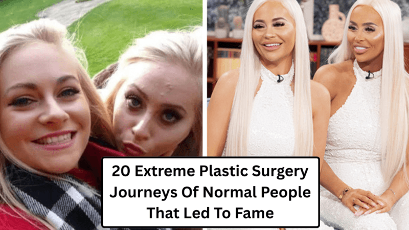 20 Extreme Plastic Surgery Journeys Of Normal People That Led To Fame