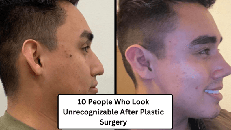 10 People Who Look Unrecognizable After Plastic Surgery