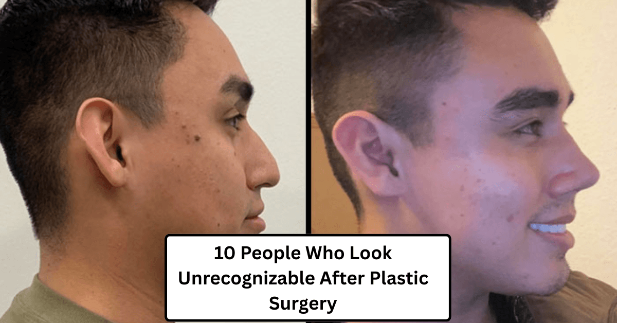 10 People Who Look Unrecognizable After Plastic Surgery