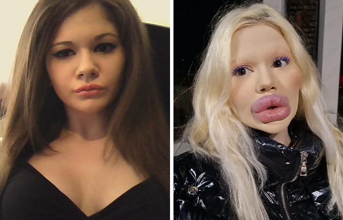 Bulgarian woman Andrea Ivanova showing her extremely enlarged lips after multiple filler injections inspired by Barbie.