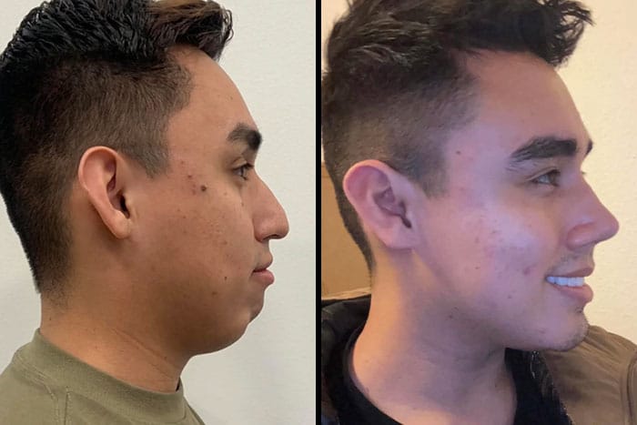 Before-and-after photos of a person who underwent chin (genioplasty) and nose (rhinoplasty) surgery, highlighting a smoother nose bridge, more proportionate chin, and overall facial harmony.