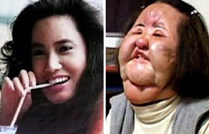South Korean woman Hang Mioku with swollen face due to self-injected oil after years of plastic surgery addiction.