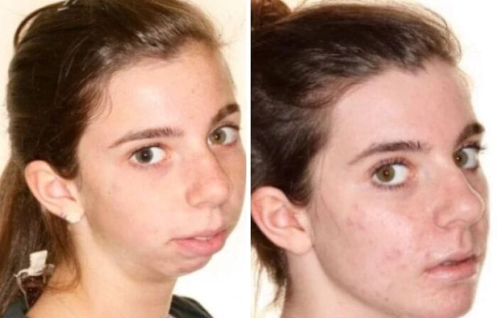 Comparison photos showing the transformation after orthognathic (jaw) surgery, with visible changes in the lower face and jawline, creating a more symmetrical and refined look.
