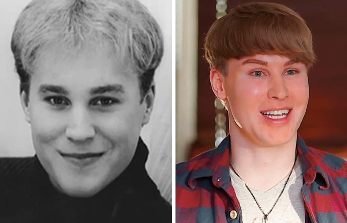 Toby Sheldon smiling post-surgery after spending thousands to resemble pop star Justin Bieber.